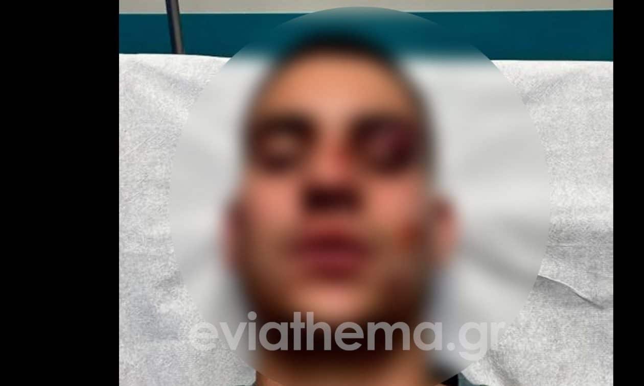 Χαλκίδα:-18χρονος-έστειλε-στο-νοσοκομείο-με-κατάγματα-19χρονο-για-ένα-like